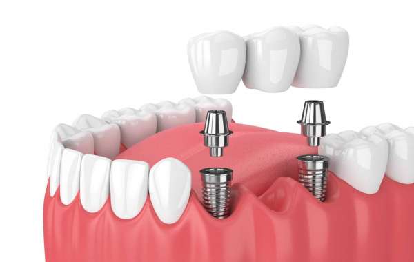 Dental Implants in Christiansted