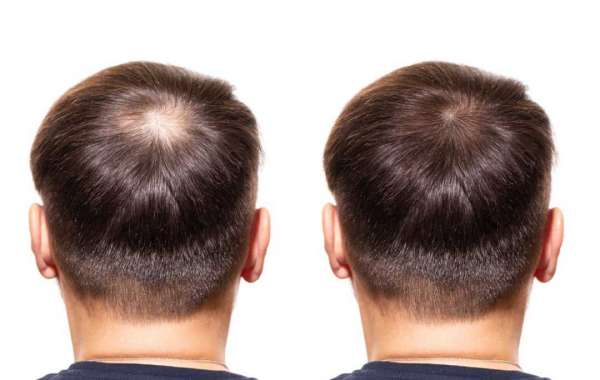 Scalp micro pigmentation hair loss